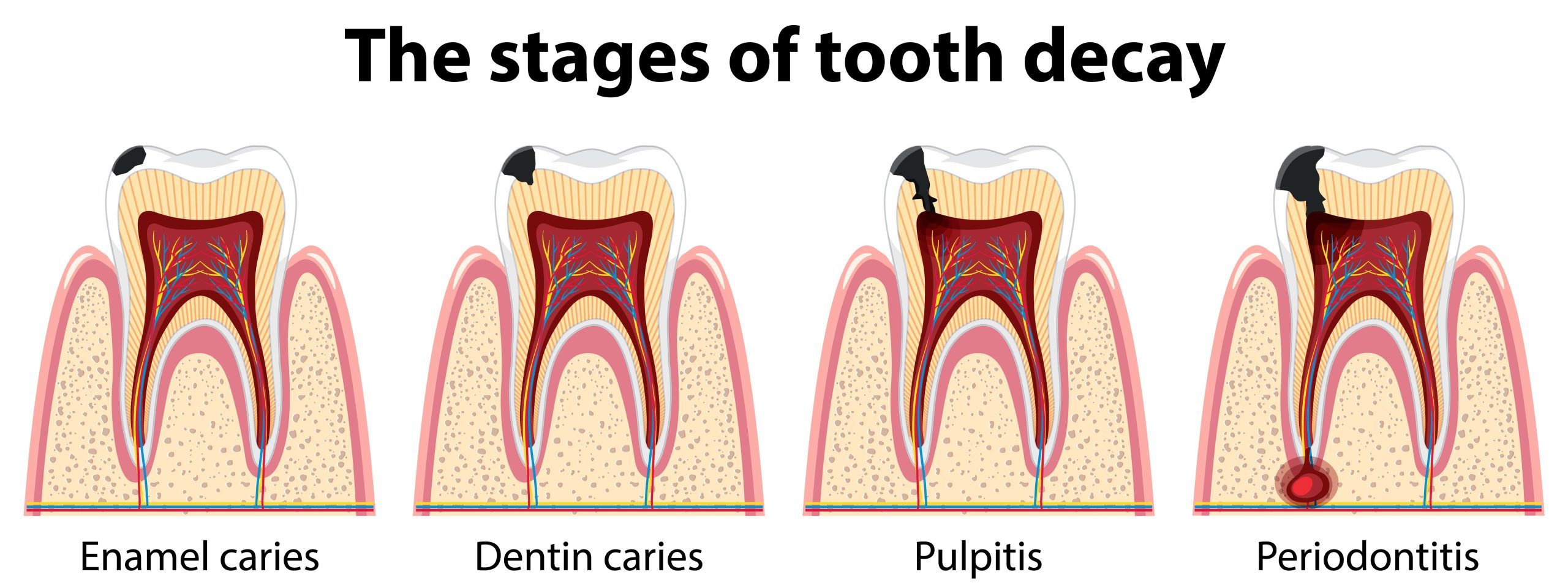 tooth decay dentist Sydney